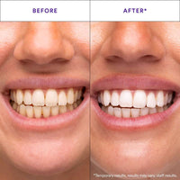 Hismile™ Whitening Strips