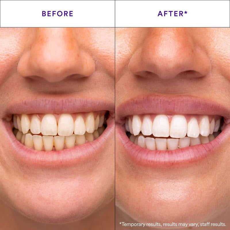 Hismile™ Whitening Strips