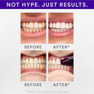 Hismile™ Whitening Strips